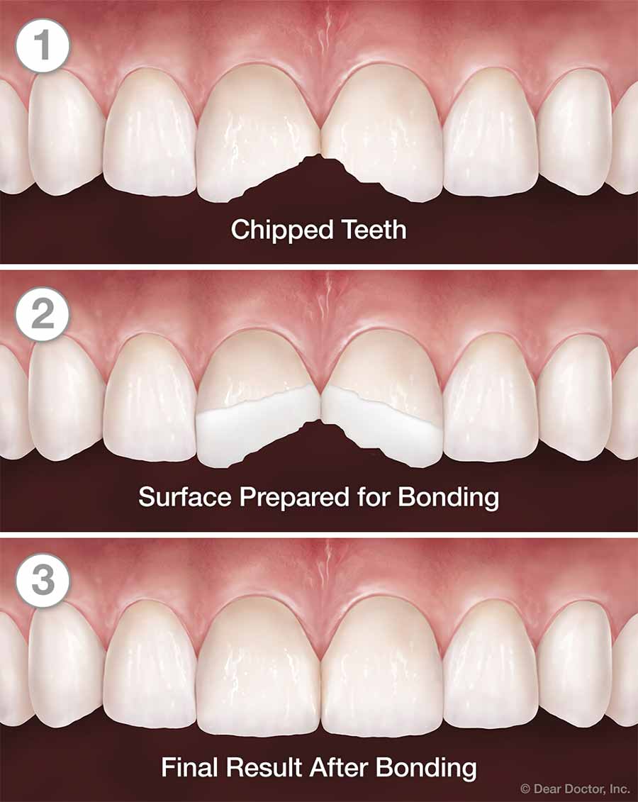 COMPOSITE FILLINGS