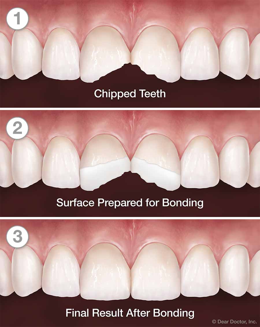 bonding tooth teeth dental chipped composite cosmetic fillings broken procedure does dentistry process dentist structure chart missing