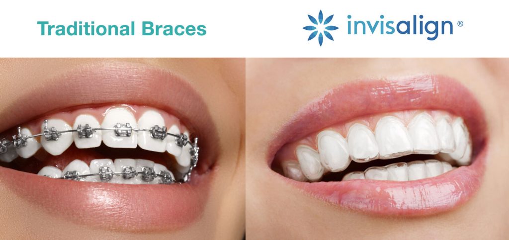 Chagrin Falls Invisalign